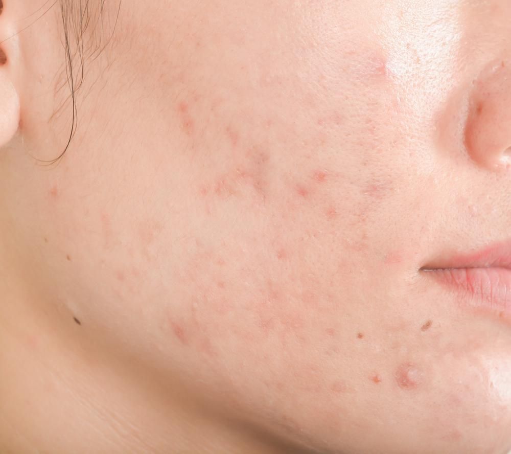A Close Up Of A Woman's Face With Acne On It — Mackay Skin Clinic In North Mackay, QLD