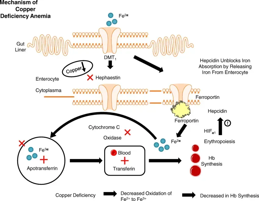 Diagram: Copper deficiency anemia mechanism. Copper deficiency impairs iron absorption and Hb synthesis.
