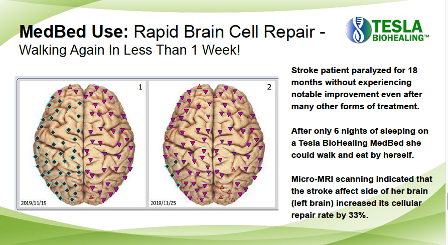 Brain scan comparison. Before and after MedBed use. Walking again in less than one week.