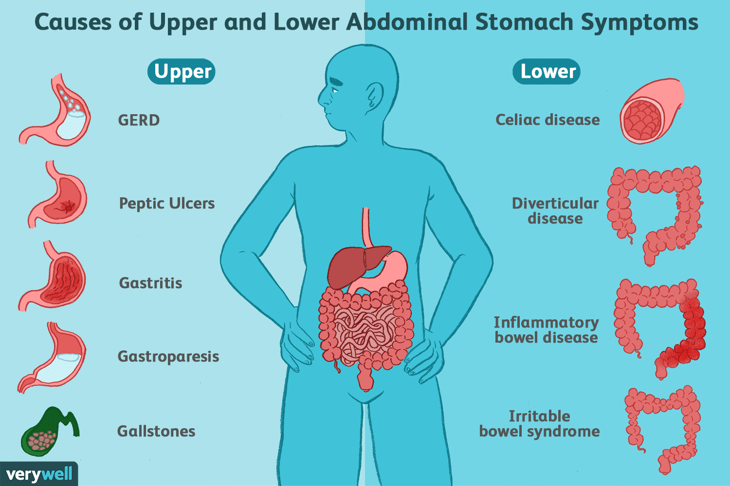 Diagram: Causes of upper/lower abdominal symptoms, with labeled medical conditions next to human body.