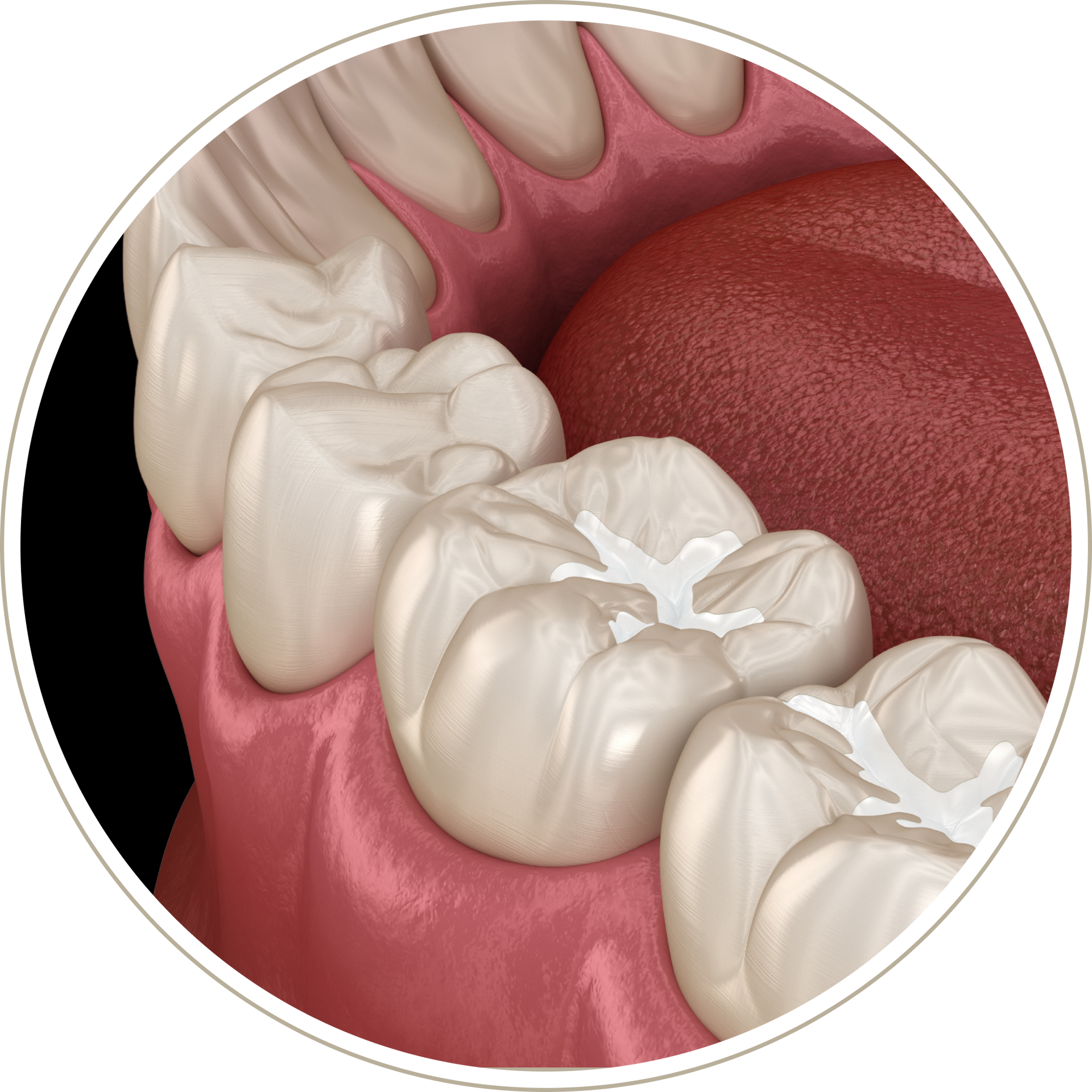 A computer generated image of a person 's teeth with dental implants.