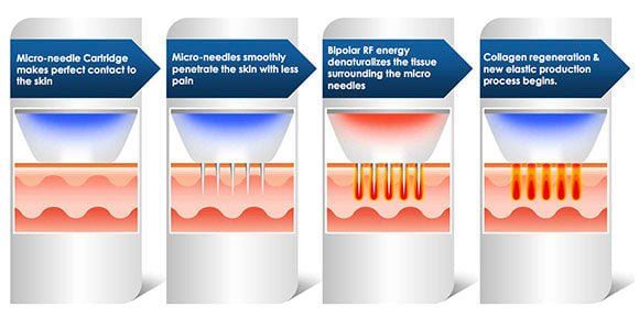 Microneedling