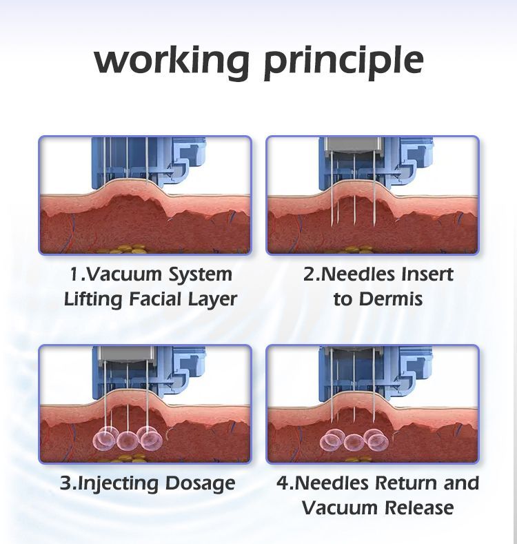 Radiofrequenz Microneedling