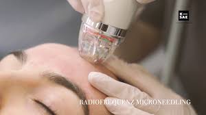 Microneedling
