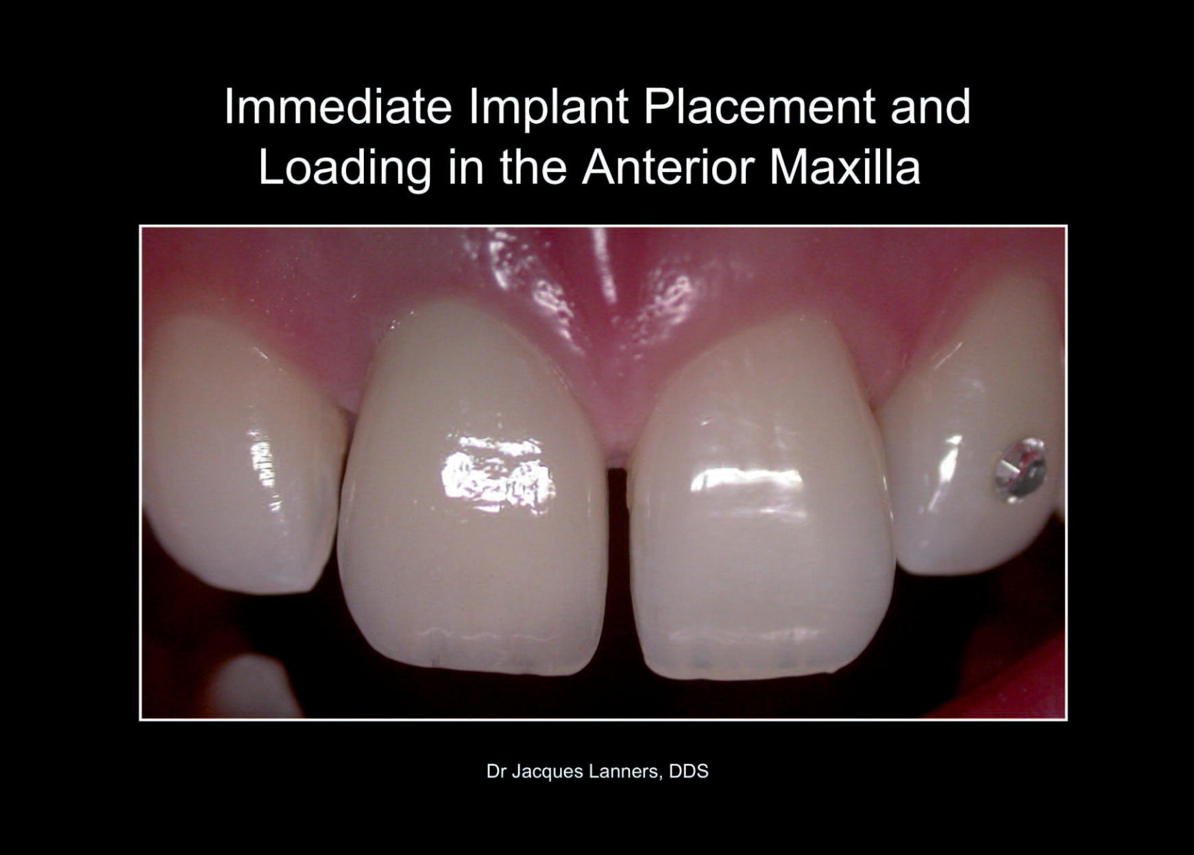 Mise en place et mise en charge immédiates de l'implant dans le maxillaire antérieur