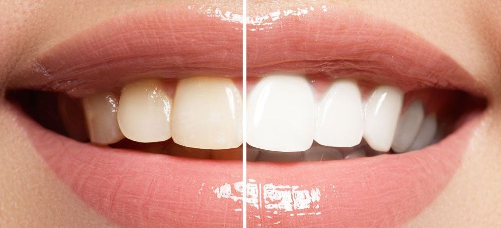 Gros plan des dents d'une femme avant et après le blanchiment.
