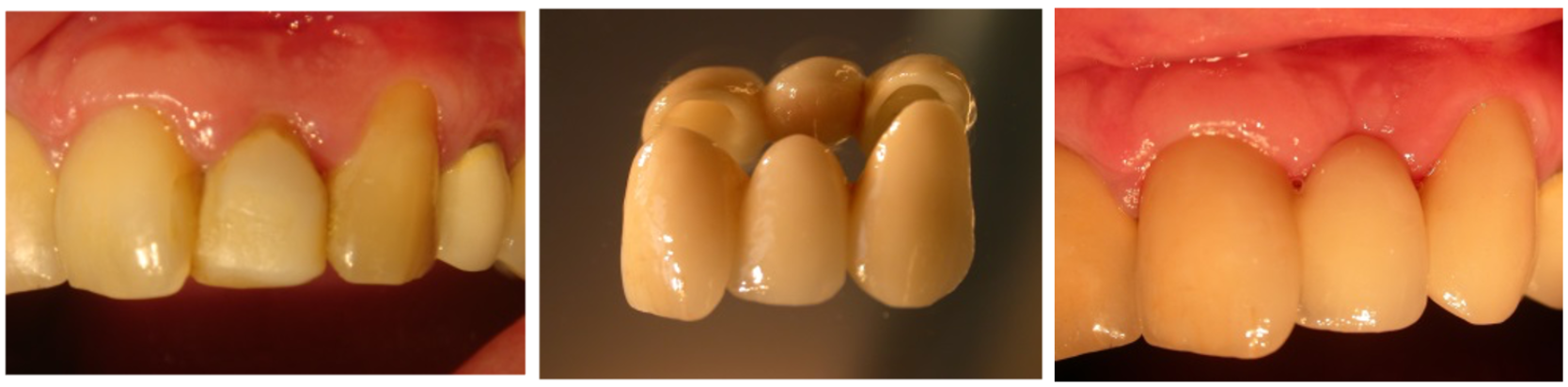 Un collage de trois photos des dents d'une personne
