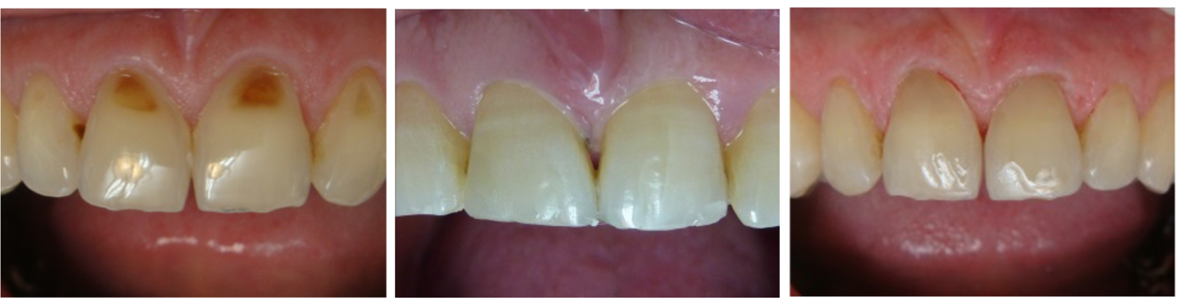 Une photo avant et après des dents d'une personne