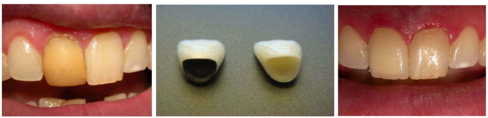 Un collage de trois photos des dents d'une personne