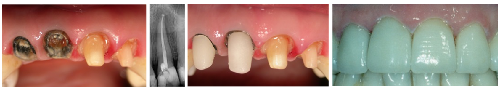Un collage de trois photos des dents d'une personne montrant différents stades de carie dentaire.