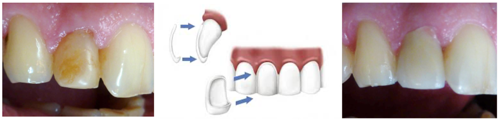 Une photo avant et après des dents d'une personne.