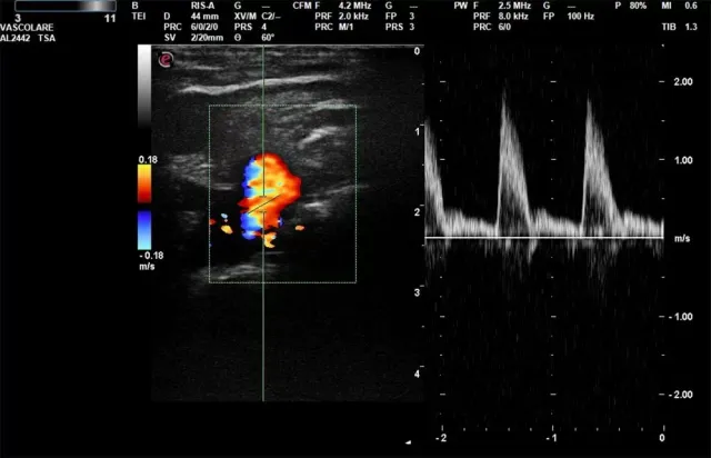 Ecografia con visualizzazione Doppler a colori del cuore e grafico della forma d'onda pulsante a destra.