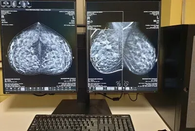 Due monitor che visualizzano immagini mammografiche in scala di grigi sopra una tastiera in un ambiente di lavoro clinico.