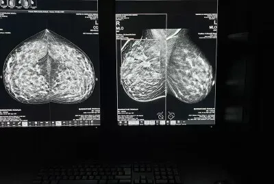 Due immagini di una mammografia visualizzate su un monitor in una stanza buia.