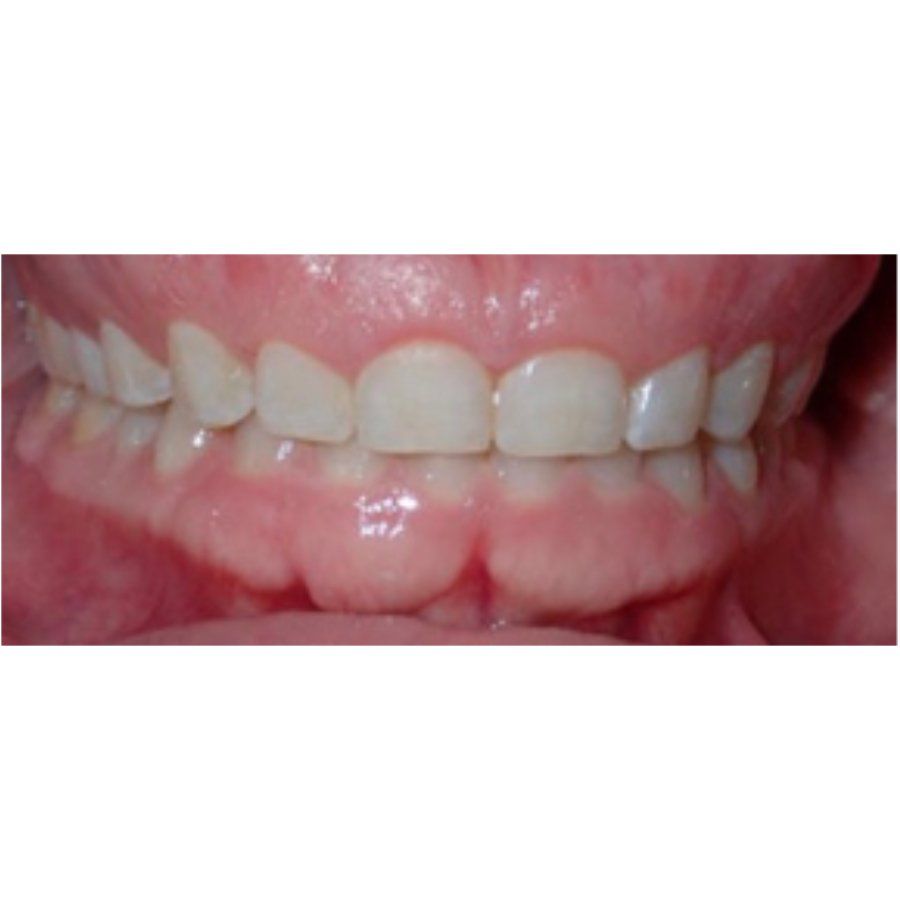 Front Bite Photo Example