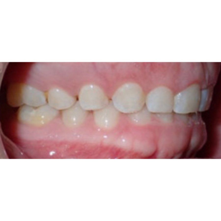 Right Bite Photo Example