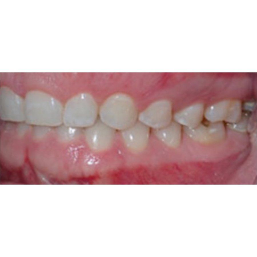 Left Bite Photo Example