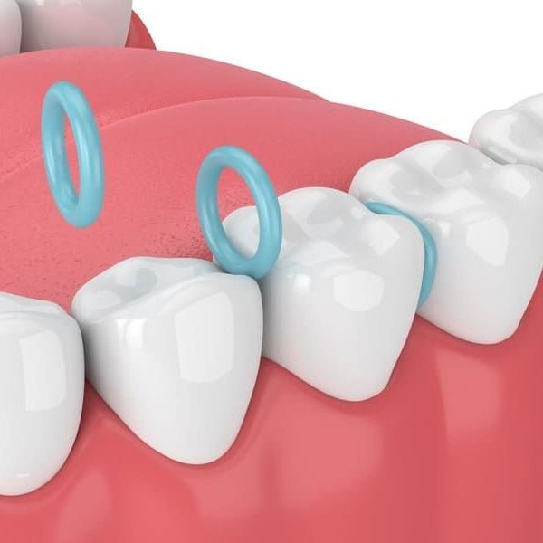 A close up of a row of teeth with blue rings on them