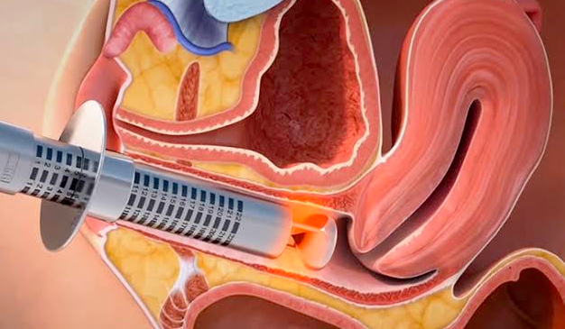 Imagem demonstrando tratamento de laser vaginal.