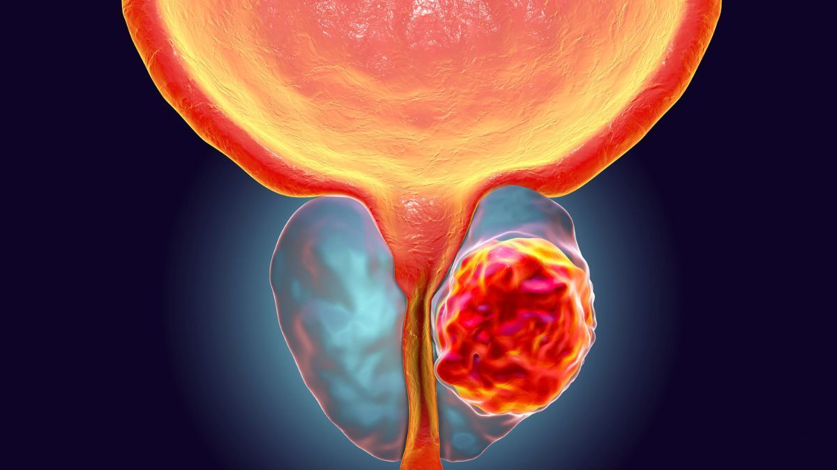 Tumore della Prostata | Poliambulatorio IGEA Piacenza