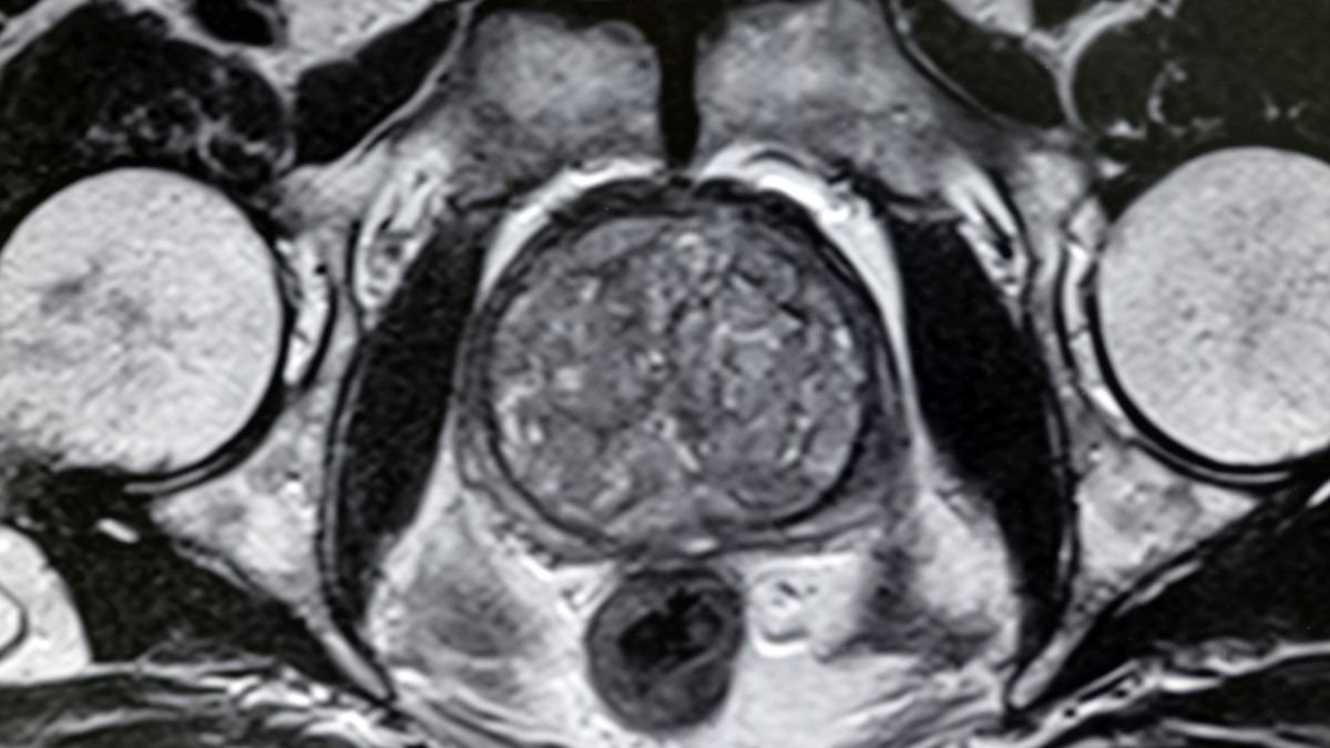 Rivascolarizzazione Arteriosa Periferica e Trattamento degli Aneurismi | Poliambulatorio IGEA Piacenza Ipertrofia Prostatica Benigna: Cause, Sintomi e Terapia | Poliambulatorio IGEA Piacenza