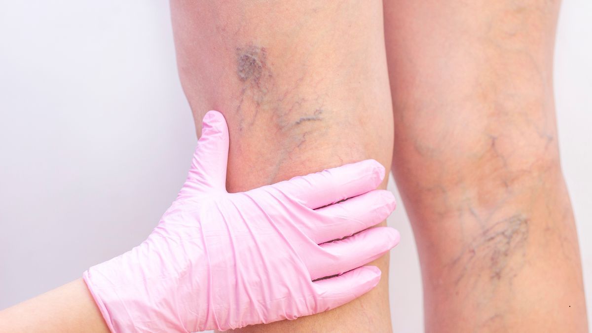 Scleroterapia per Vene e Capillari | Poliambulatorio IGEA Piacenza