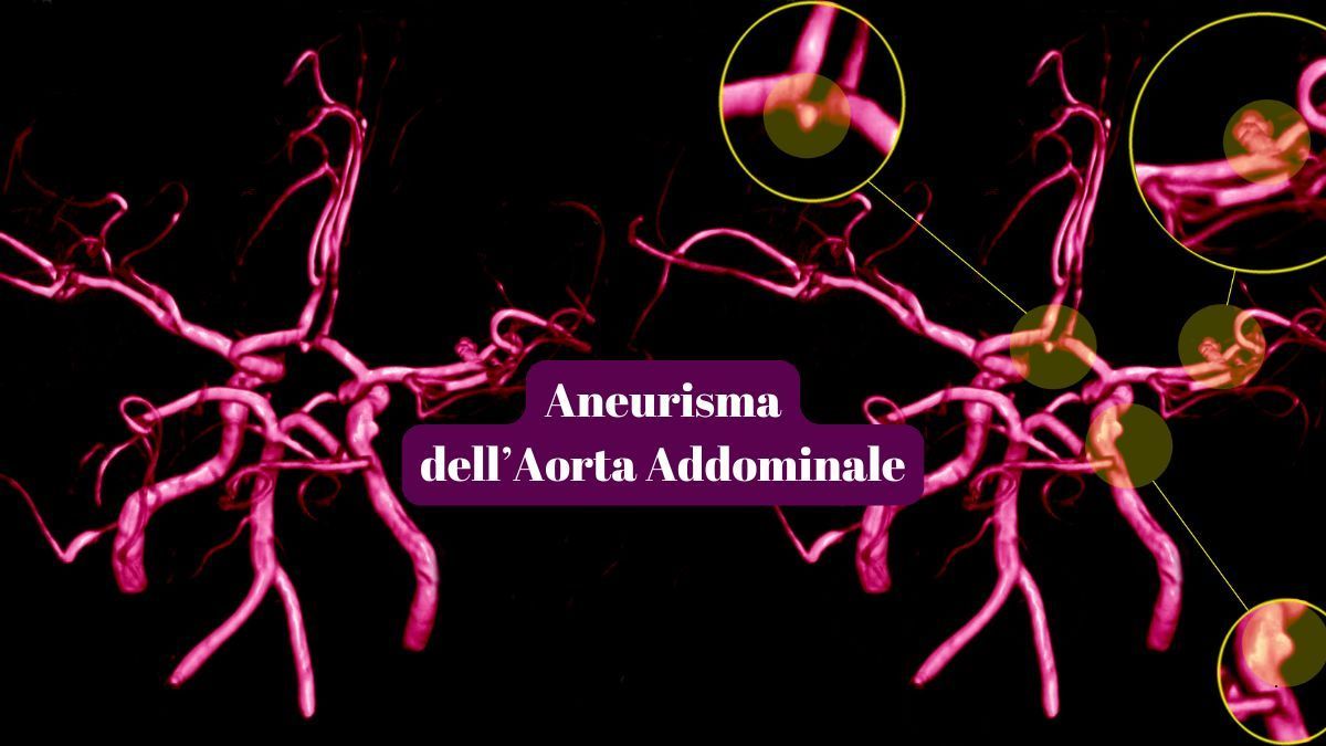Aneurismi dell’aorta addominale: Cause, Sintomi e Trattamenti | Poliambulatorio IGEA Piacenza Aneurismi dell’aorta addominale: Cause, Sintomi e Trattamenti | Poliambulatorio IGEA Piacenza