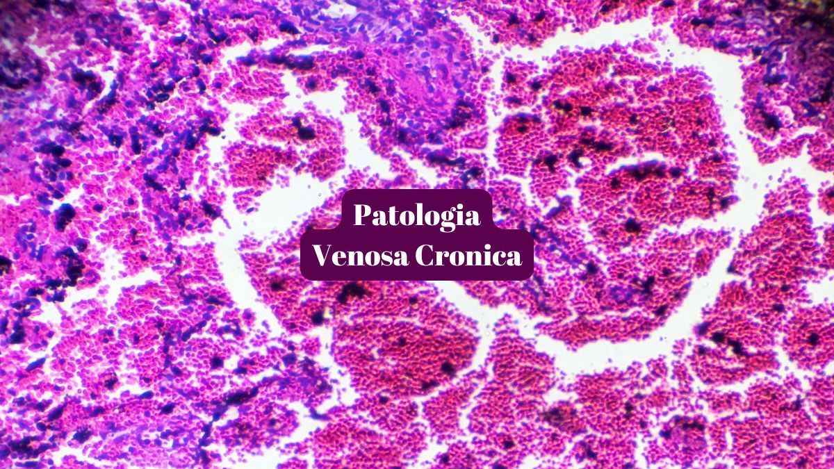 Patologia venosa cronica: Cause, Sintomi e Trattamenti | Poliambulatorio IGEA Piacenza Patologia venosa cronica: Cause, Sintomi e Trattamenti | Poliambulatorio IGEA Piacenza