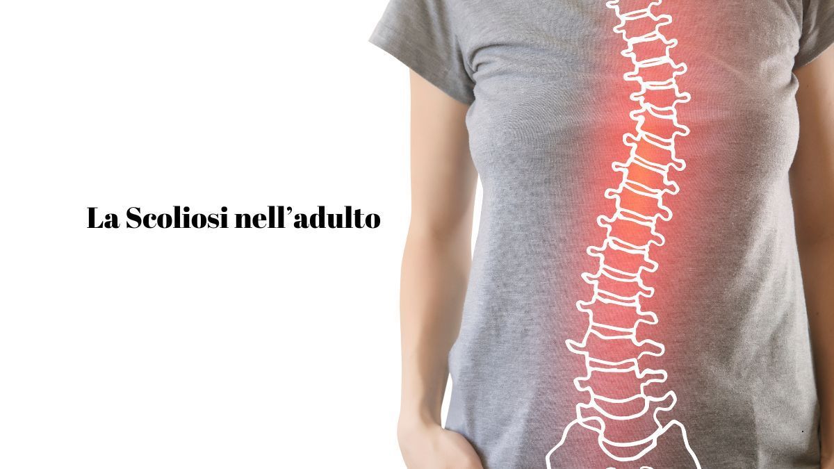 La Scoliosi nell'Adulto: Cause Sintomi e Trattamento | Poliambulatorio IGEA Piacenza La Scoliosi nell'Adulto: Cause Sintomi e Trattamento | Poliambulatorio IGEA Piacenza