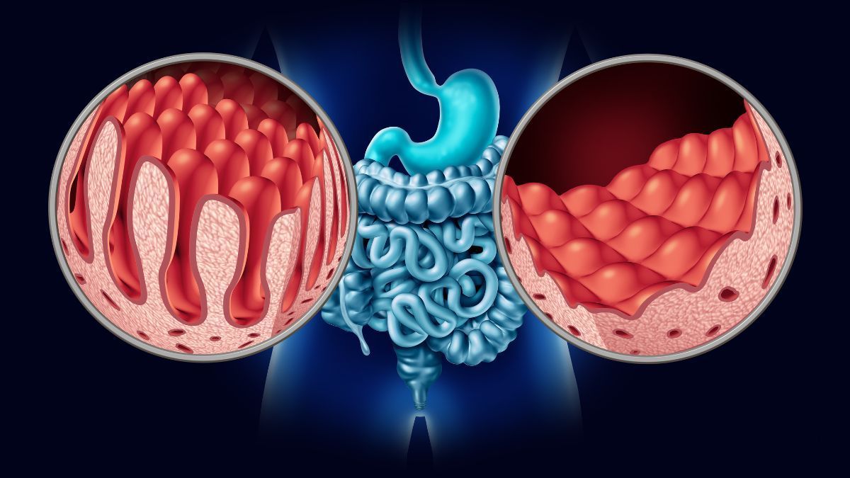 Stipsi: comprendere e gestire la costipazione | Poliambulatorio IGEA Piacenza Malattia celiaca: riconoscere e gestire una malattia autoimmune | Poliambulatorio IGEA Piacenza