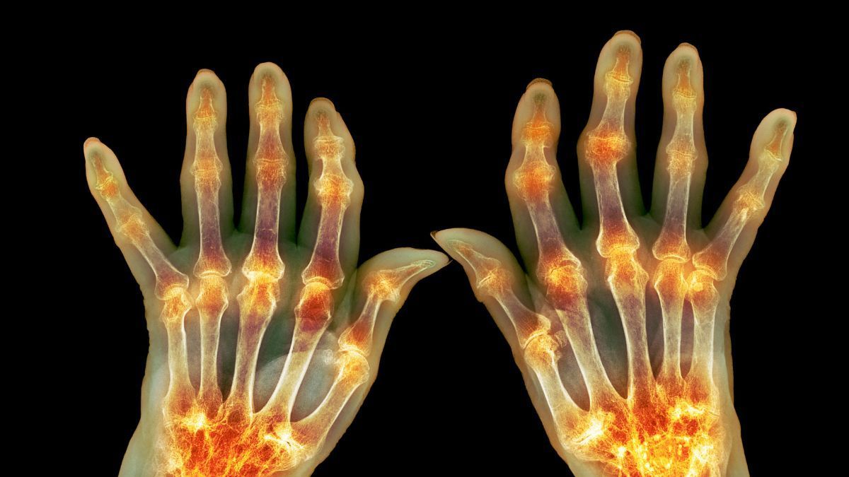 Sindrome del Tunnel Carpale: Cause, Sintomi e Trattamenti | Poliambulatorio IGEA Piacenza ARTRITE REUMATOIDE – UNA MALATTIA AUTOIMMUNE CHE COLPISCE LE ARTICOLAZIONI | Poliambulatorio IGEA Piacenza