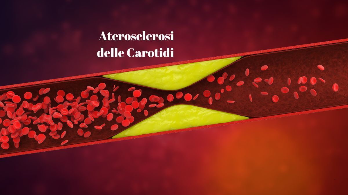 Aterosclerosi delle Carotidi: Cause, Sintomi e Trattamenti | Poliambulatorio IGEA Piacenza Aterosclerosi delle Carotidi: Cause, Sintomi e Trattamenti | Poliambulatorio IGEA Piacenza