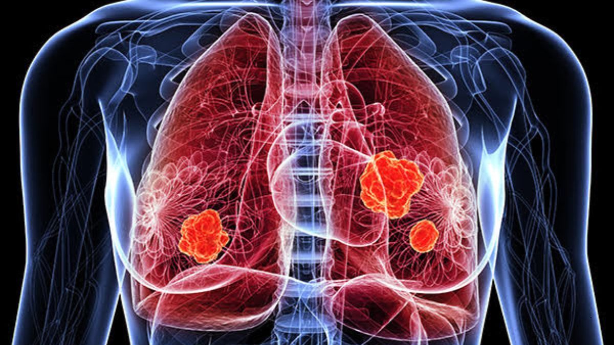 Neoplasia polmonare: diagnosi e gestione della patologia Neoplasia polmonare: diagnosi e gestione della patologia | Poliambulatorio IGEA Piacenza
