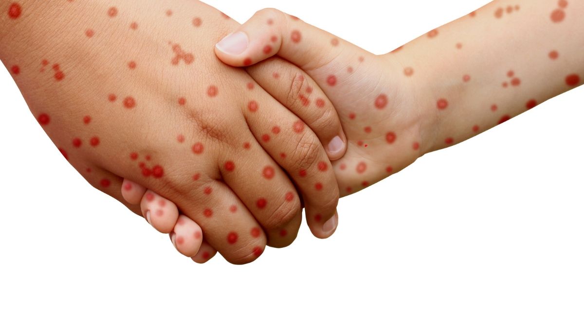 Aumento dei casi di Morbillo e Pertosse nei bambini | Poliambulatorio IGEA Piacenza Aumento dei casi di Morbillo e Pertosse nei bambini | Poliambulatorio IGEA Piacenza