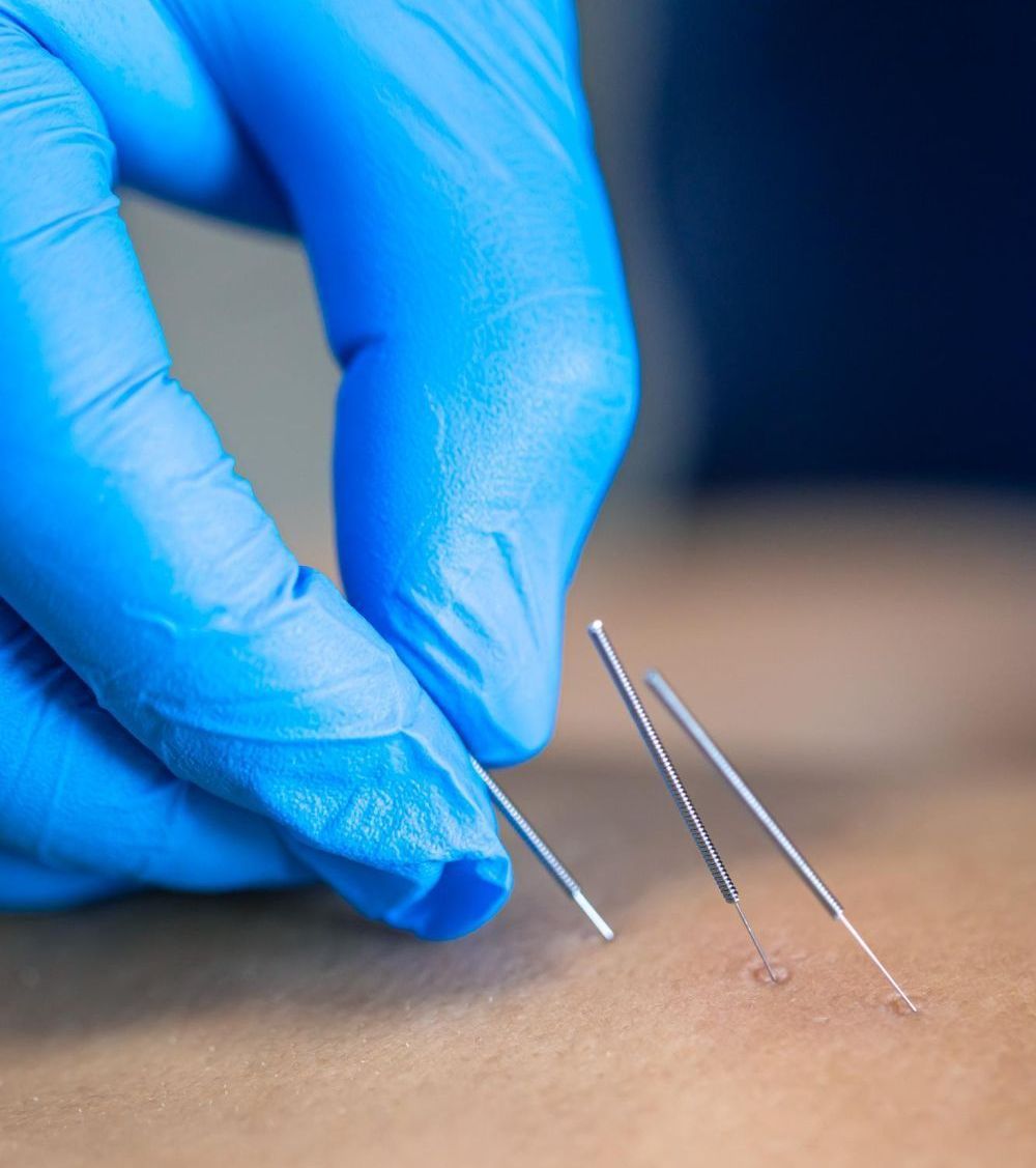 treating stress, anxiety  and emotional disorders with acupuncture