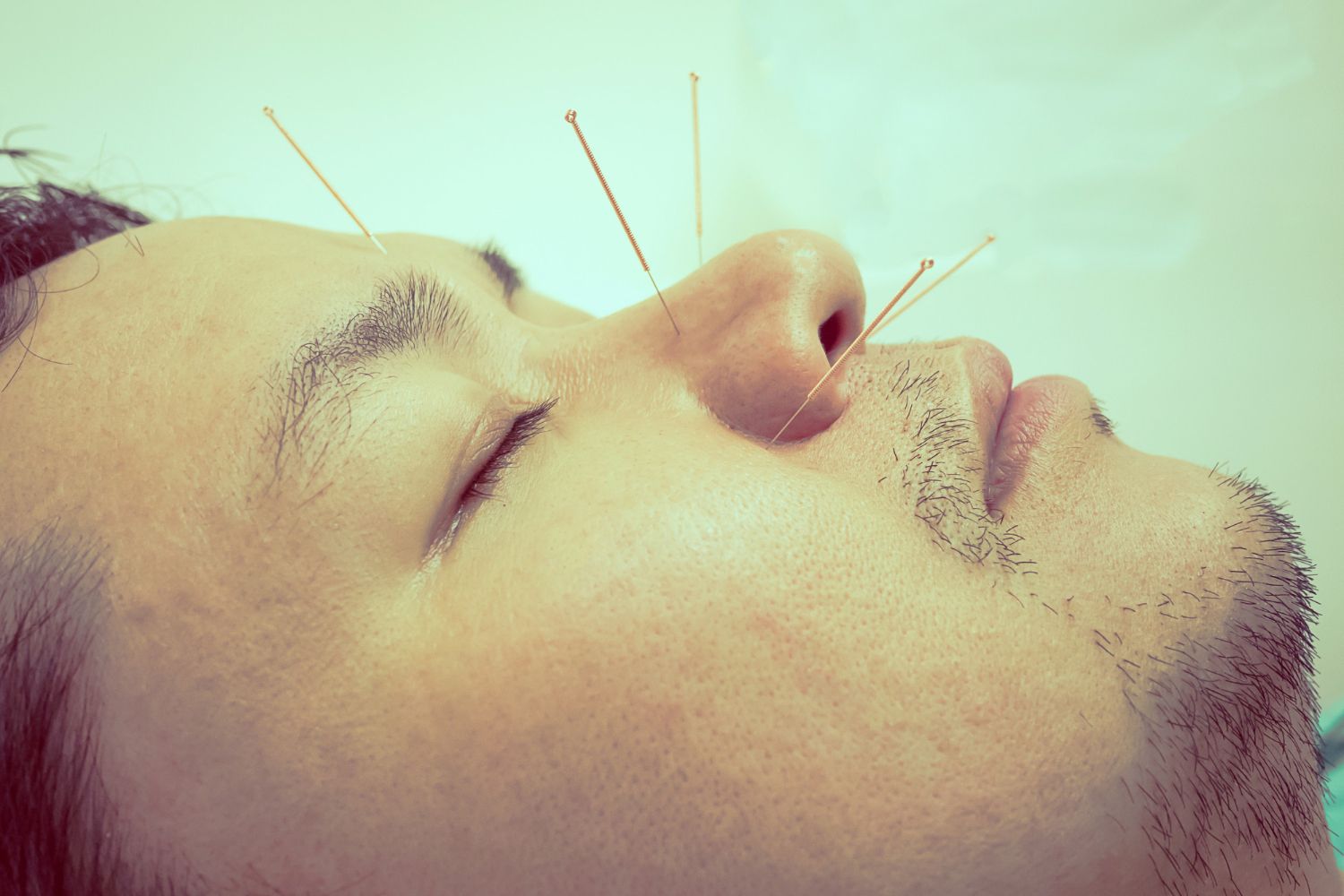 acupuncture on feet
