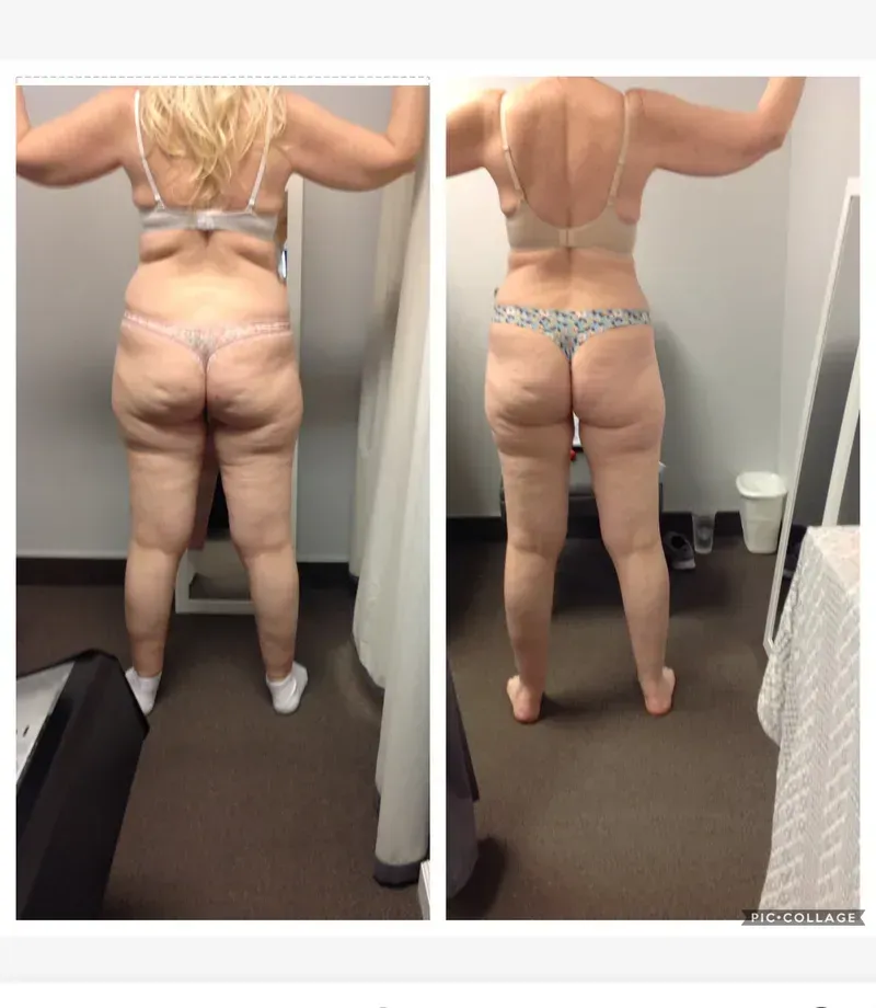 Back view comparison of a person in a sports bra and patterned shorts, standing in a hallway.