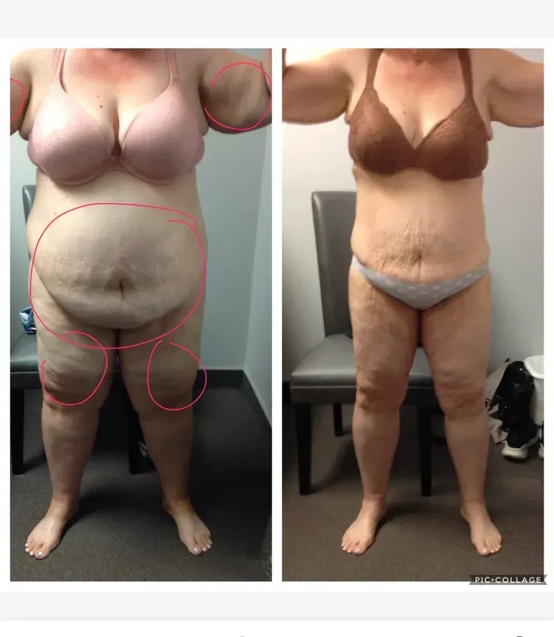 Before-and-after torso photos of a woman in a bra and underwear, with red circles highlighting body areas.