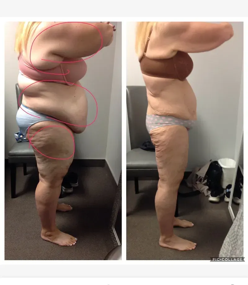 Side-by-side profile photos of a person in underwear showing body shape comparison before and after.