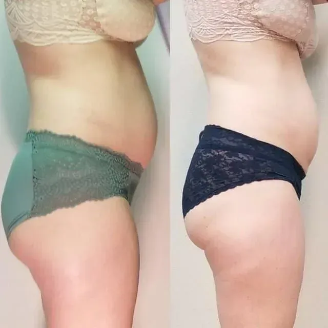 Side-by-side side views of a person in lace underwear, showing belly profile before and after.