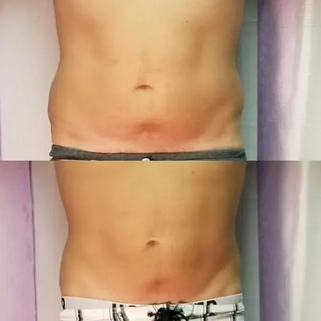 Bare torso shown with a black band around the waist and light-colored shorts at the bottom.