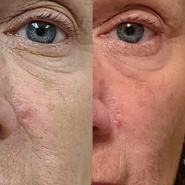 Close-up split-face comparison of a person’s eye area: pale skin on the left and red, irritated skin on the right