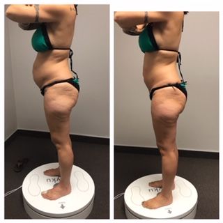 Side-by-side profile photos of a person on a scale, showing body posture and measurements in underwear.