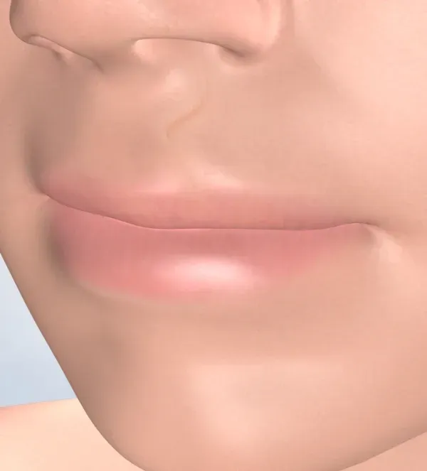 Cleft Lip & Palate