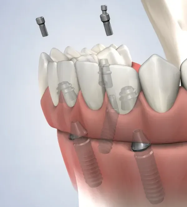 All-on-4® Treatment Concept