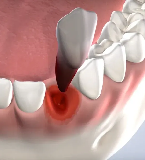 General Tooth Extractions
