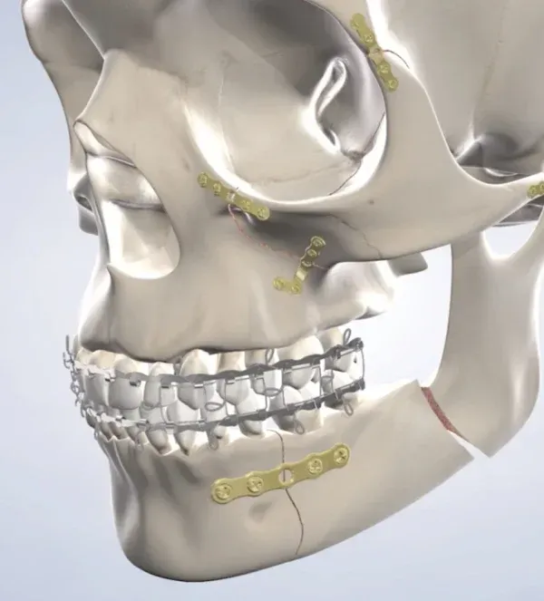 Facial Trauma