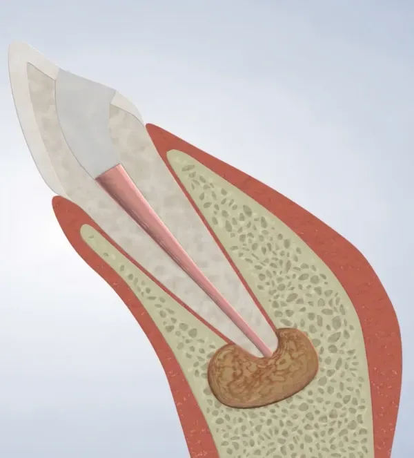 Apicoectomy
