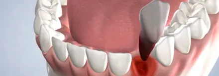 A close up of a dental implant with a tooth in it.