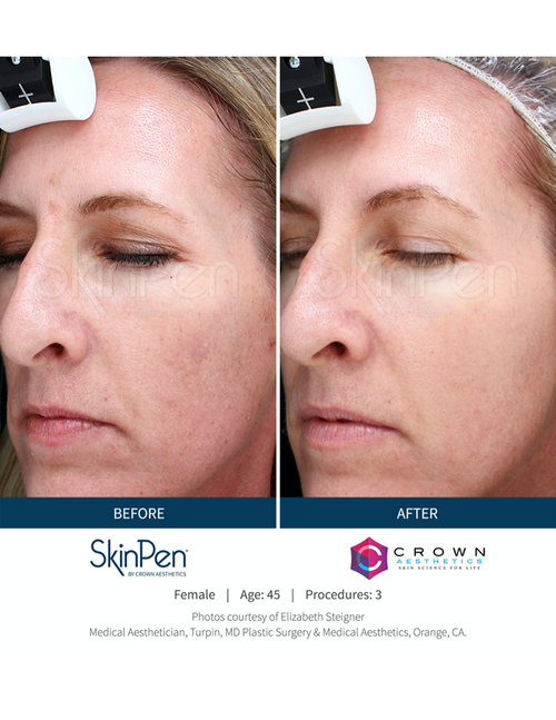 Microneedling Treatment Before and After — Bryant, AR — Practical Wellness Clinic Microneedling Treatment Before and After — Bryant, AR — Practical Wellness Clinic